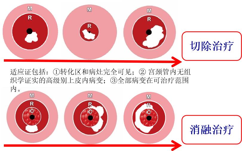 派特灵派特生物精选｜CIN的规范化诊治