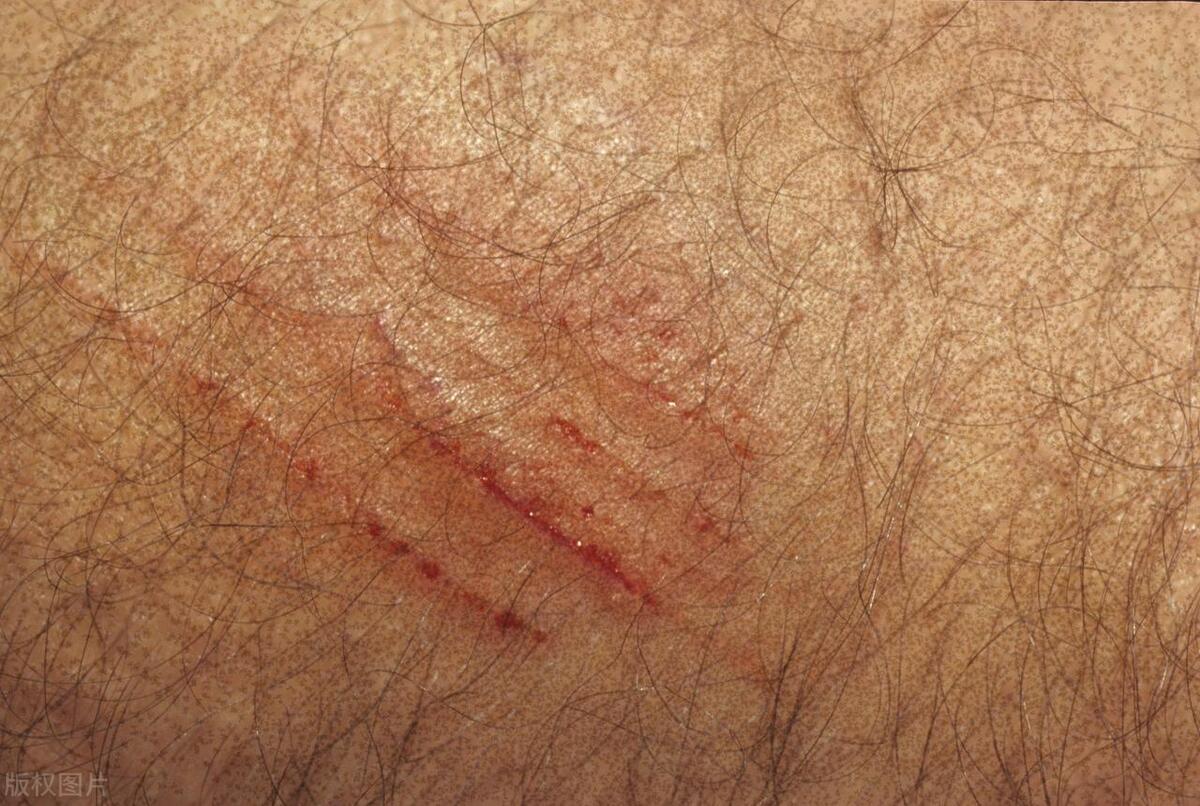 两月未互动，背后抓痕谜底，医生解释疥螨感染真相，挽救婚姻危机