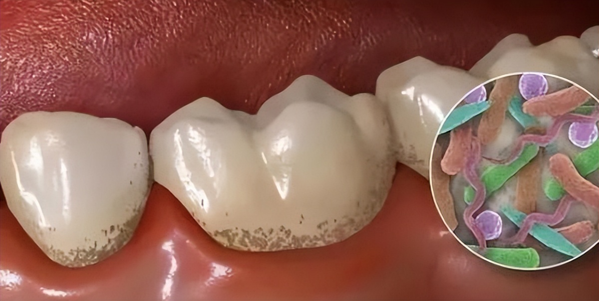 洗牙会伤害牙齿吗该不该洗牙,深度洗牙对牙齿有伤害吗