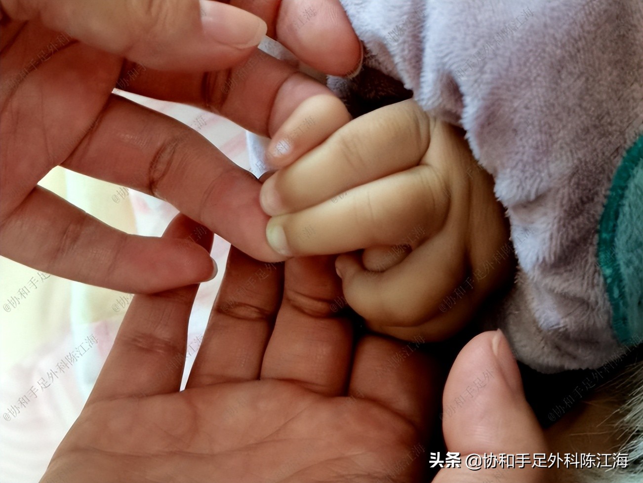 宝宝拇指畸形能矫正吗,孩子拇指畸形是什么原因