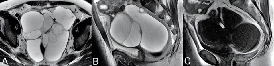 卵巢良性病变mri诊断思路,核磁共振可以看出卵巢病变吗