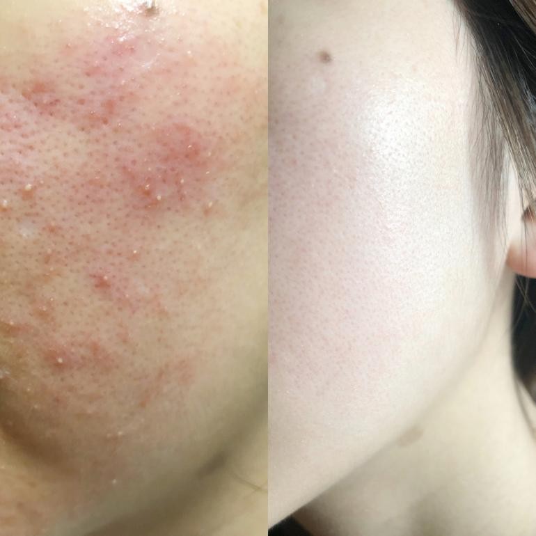 叶酸护肤品有刺激吗,孕妈可以用叶酸类护肤品吗