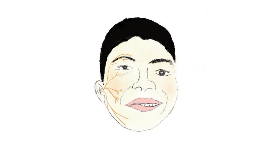 表情不受管理怎么办,表情不受控制是什么病