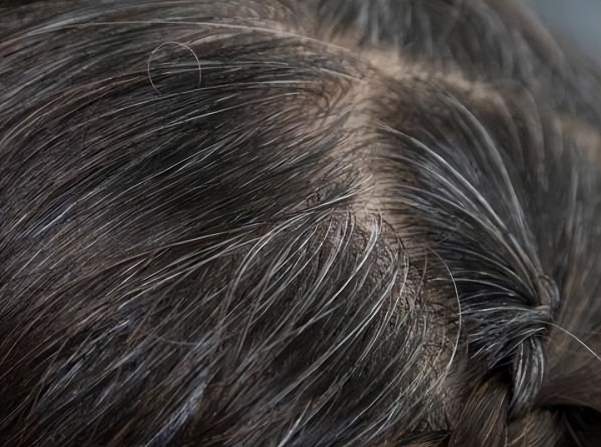 女性二十几岁白头发是什么原因,白头发严重增多怎么调理女性