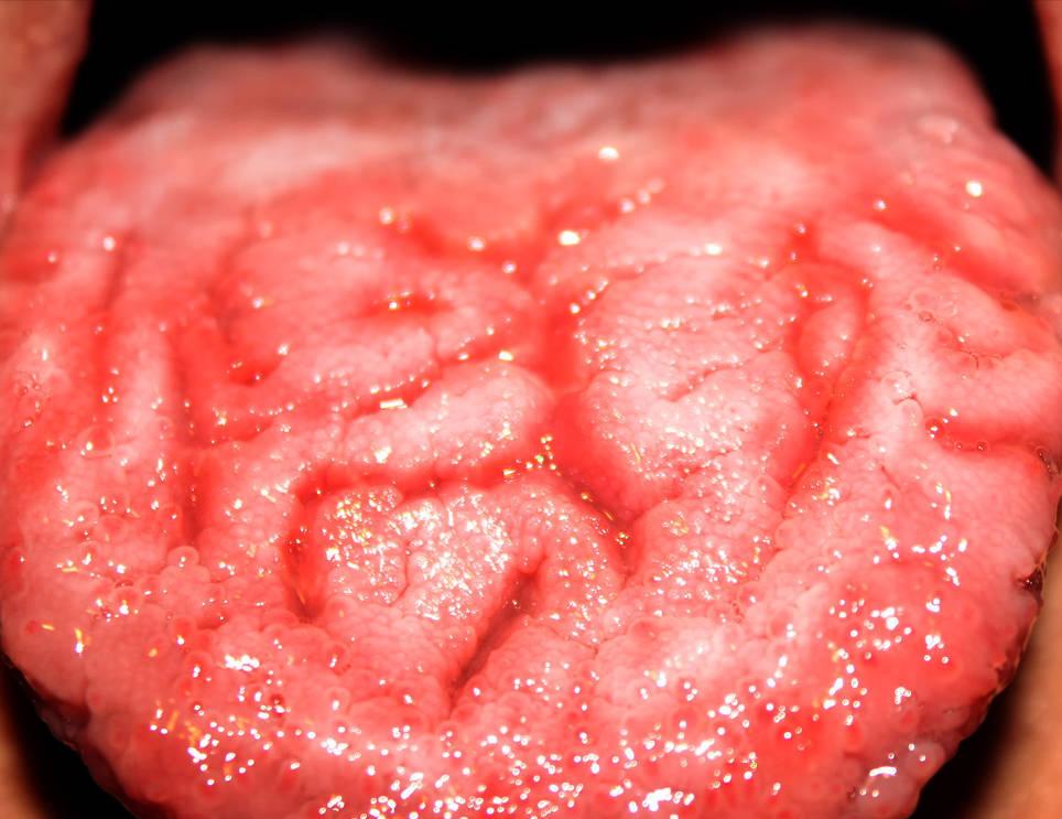 口腔疾病老是频发？可能跟糖尿病有关，日常预防需做好这5点