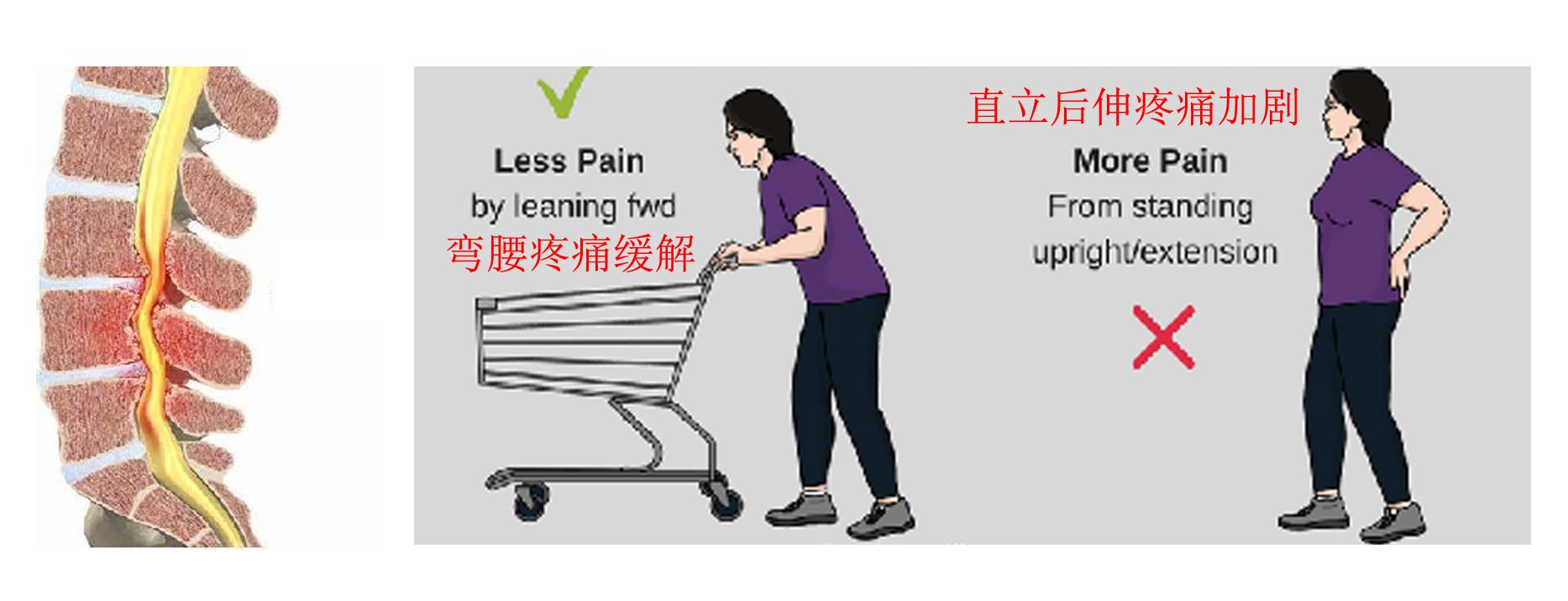 腰痛原因讲解,腰痛康复科普文章内容