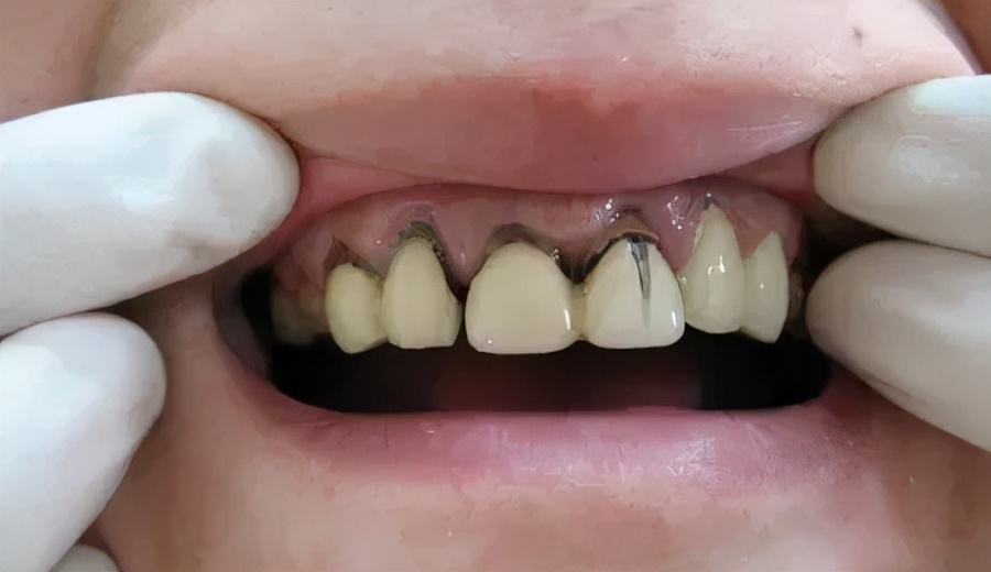 为什么牙医不愿意给我做烤瓷牙套,为什么牙医不想给病人做单冠