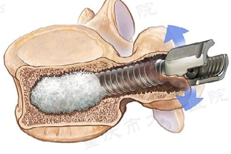骨水泥螺钉治疗腰椎骨折,骨水泥钉技术