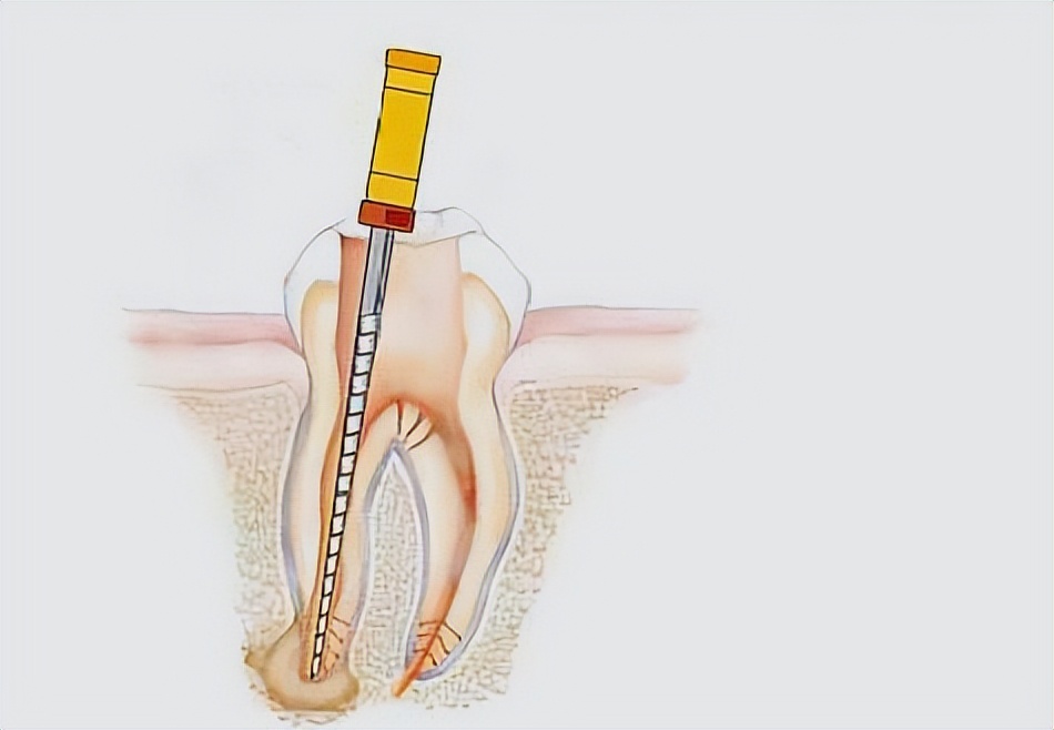 13岁女孩做根管治疗竟将针管断在牙龈里。什么是根管治疗？