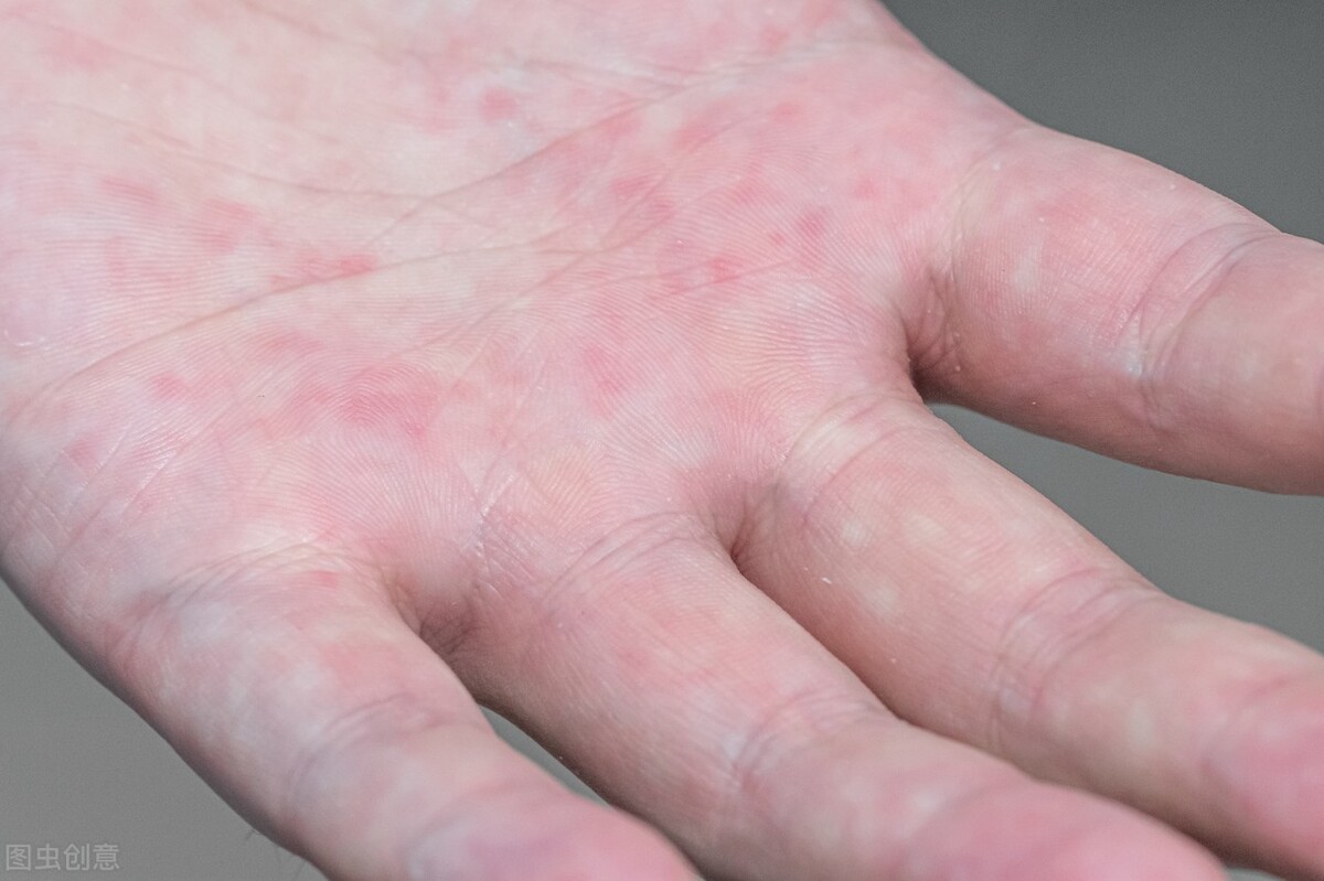 手汗是虚弱导致的吗,体虚手汗多怎么办