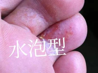 用过足光散后一直脱皮不好,用了足光散脱皮正常吗