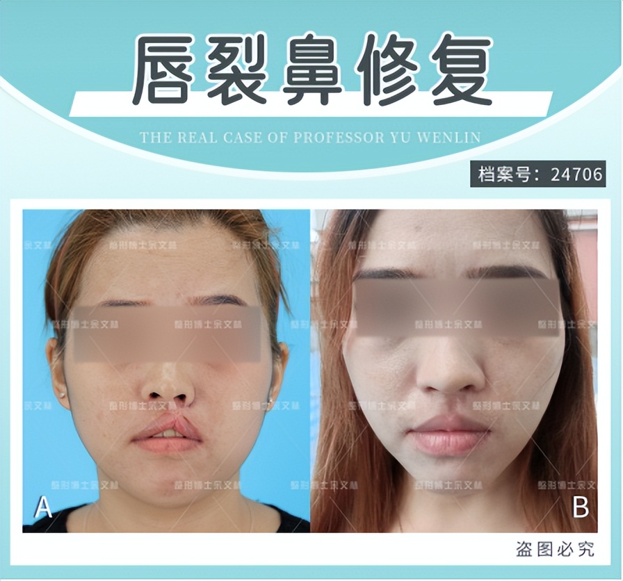 唇裂疤痕修复,唇裂修复后的疤痕怎么处理