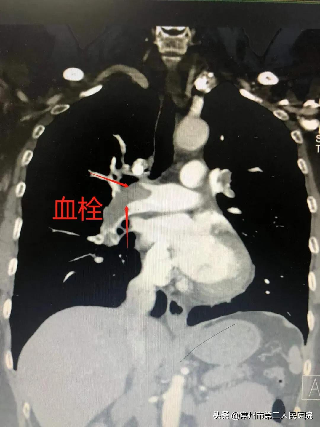 肺栓塞可怕的杀手,肺栓塞凶险么