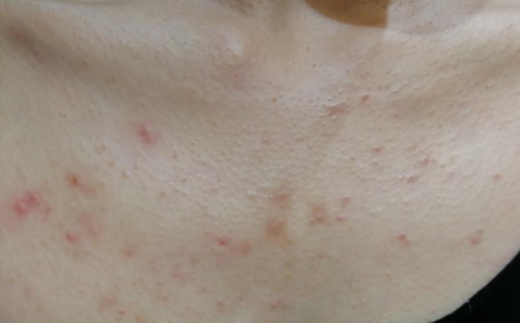 胃火肺火的症状有哪些,胃火旺和肺火旺的症状