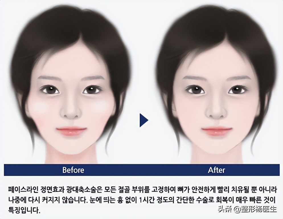 颧骨内推耳前凸起,鼻骨内推和颧骨内推可以一起做吗