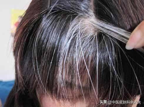 两鬓和后脑出现白发是什么原因,前额两鬓白发的原因及解决方法
