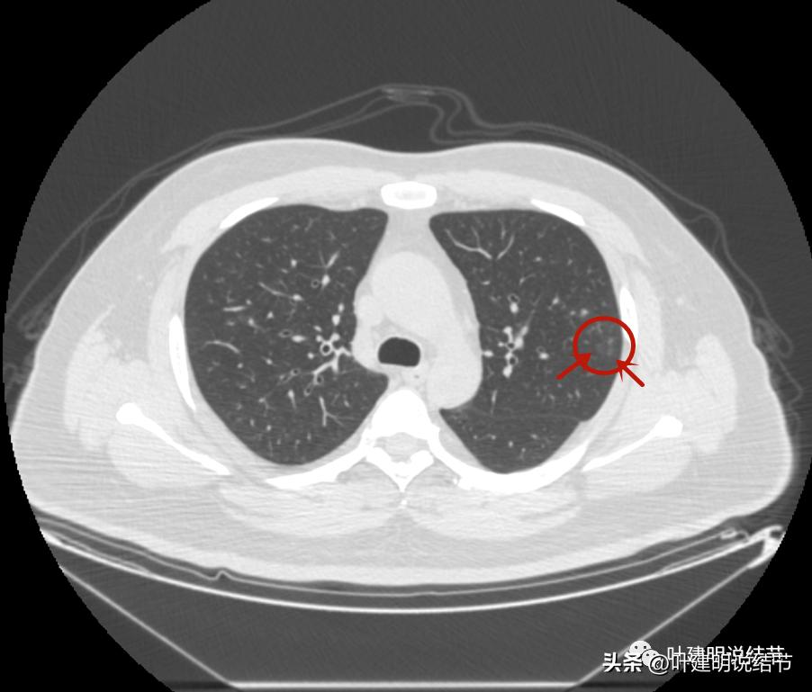 如何判断肺磨玻璃结节是高危结节,肺上有混合磨玻璃结节要注意什么