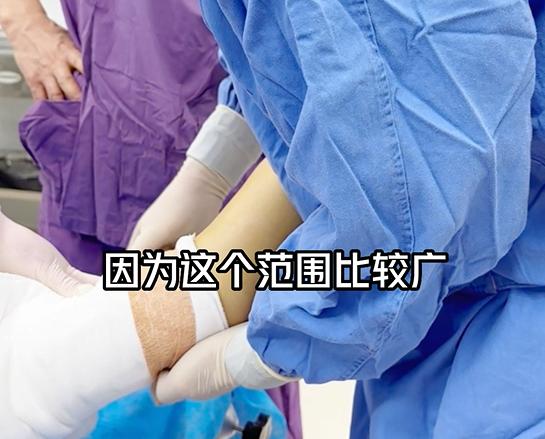 瘦手臂最快的方法吸脂,吸脂瘦手臂前后对比图