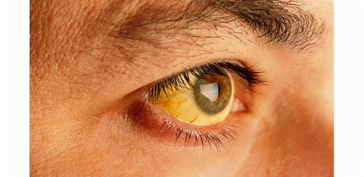 生气会引起胃出血,食管静脉曲张是呕血还是排黑便