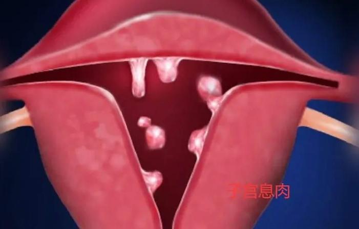 内膜息肉的克星,中医能治内膜增生和息肉吗