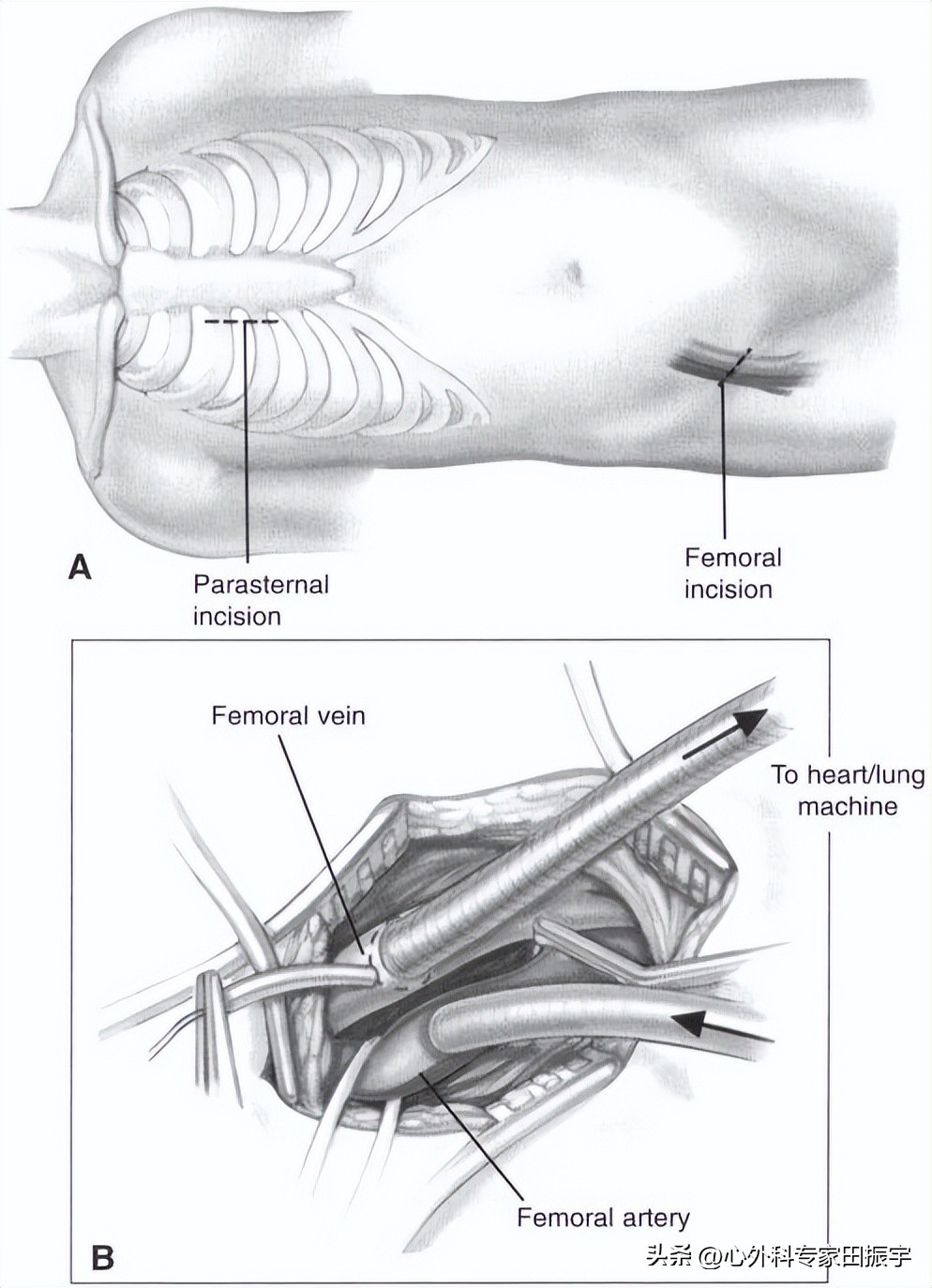 二尖瓣成形术要多少钱,二尖瓣成形术后抗凝多久