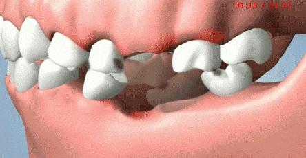 正畸治疗的基本矫治方法,正畸修复联合案例