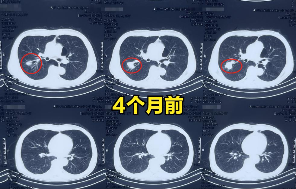 肺癌穿刺活检会使癌症发展得快吗,肺癌穿刺活检的风险