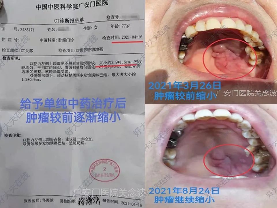 正确使用中医药治疗肿瘤才显效,关于中医中药在肿瘤治疗中的见解