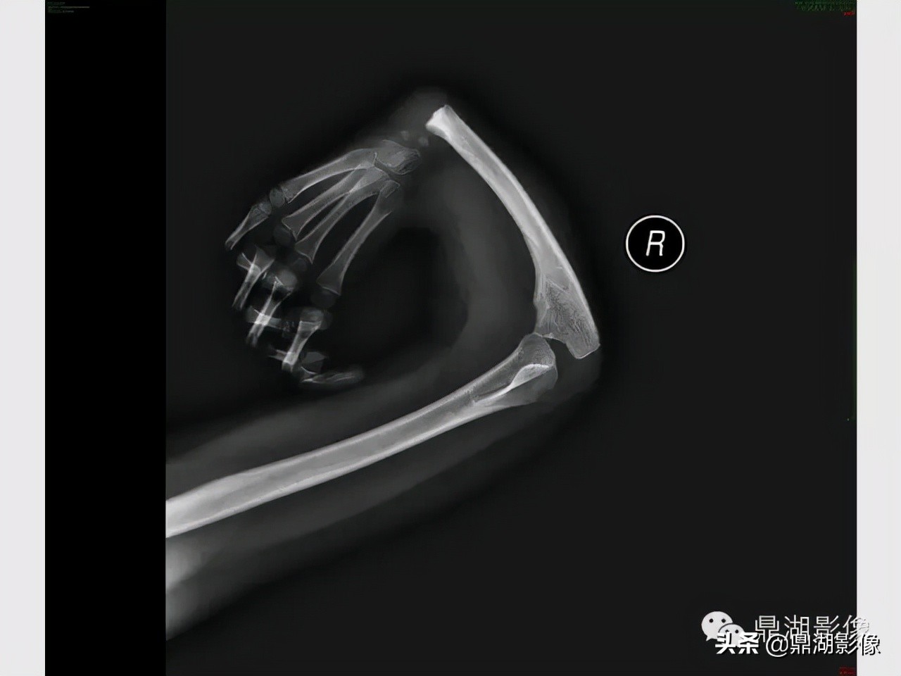 先天桡骨缺失畸形能治疗吗,先天性桡骨发育不良