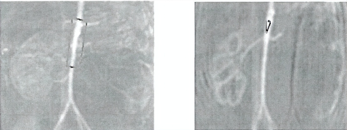 中医治疗宝宝肾积水输尿管狭窄,小儿肾积水和输尿管扩张怎么治疗
