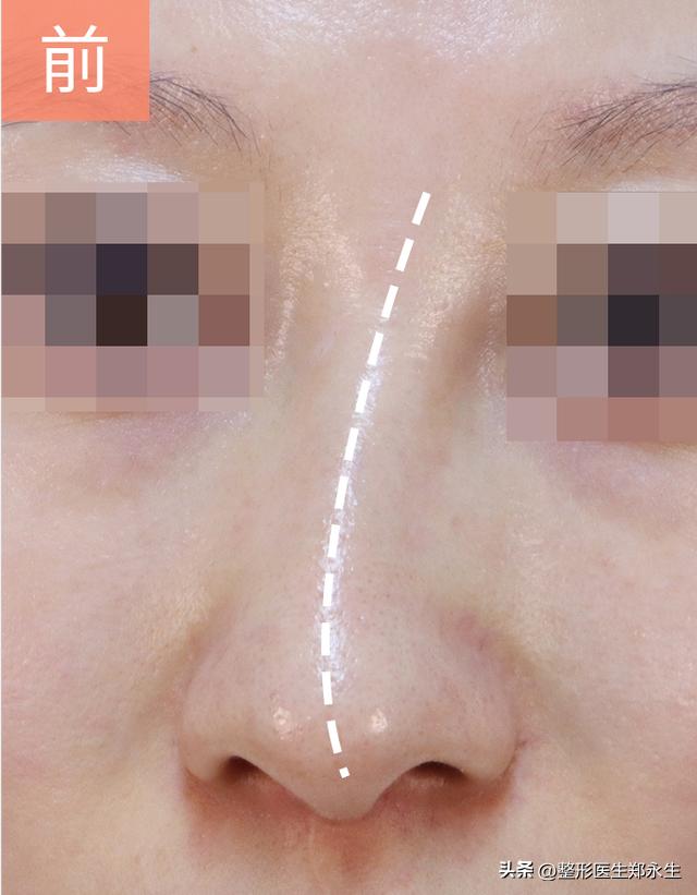 歪鼻子的最佳治疗方法,经常歪鼻子会怎么样