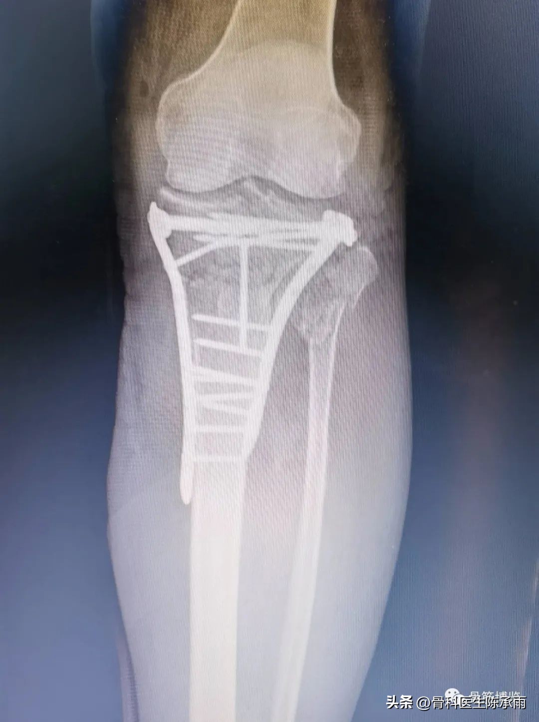 膝关节胫骨平台骨折,最近胫骨平台骨折视频