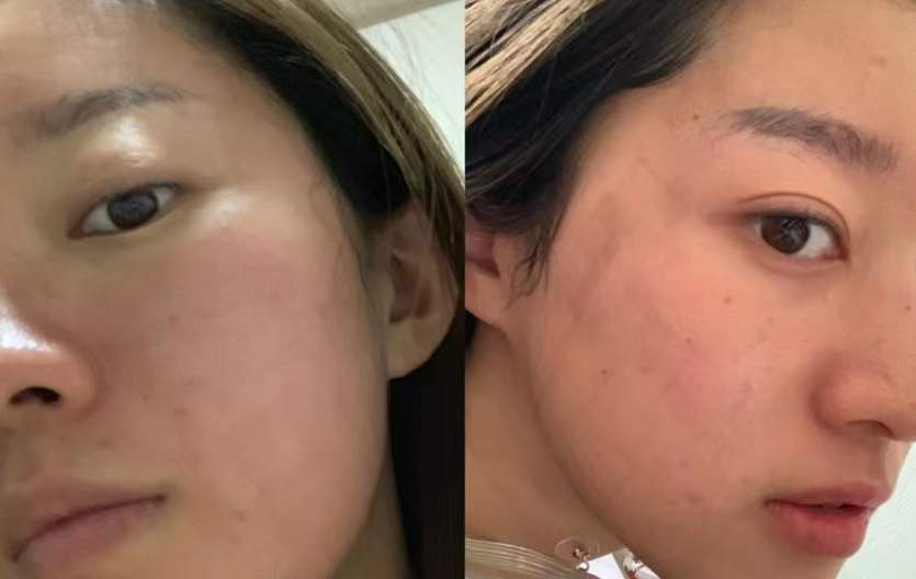 收缩毛孔激光点阵真实效果,毛孔缩小最有效的办法用点阵激光