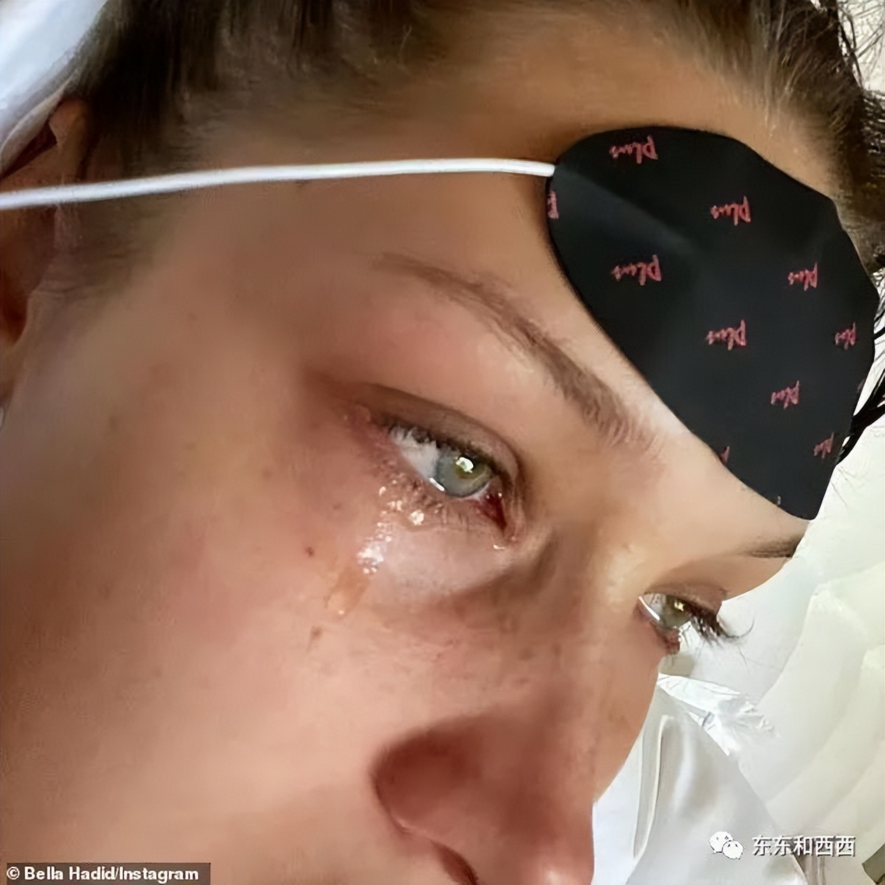 给女儿整鼻子,给两个女儿整鼻子