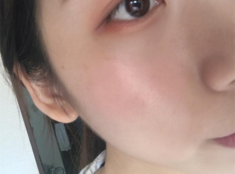 脸上毛孔粗大和遗传有关系吗,遗传性毛孔粗大怎么改善