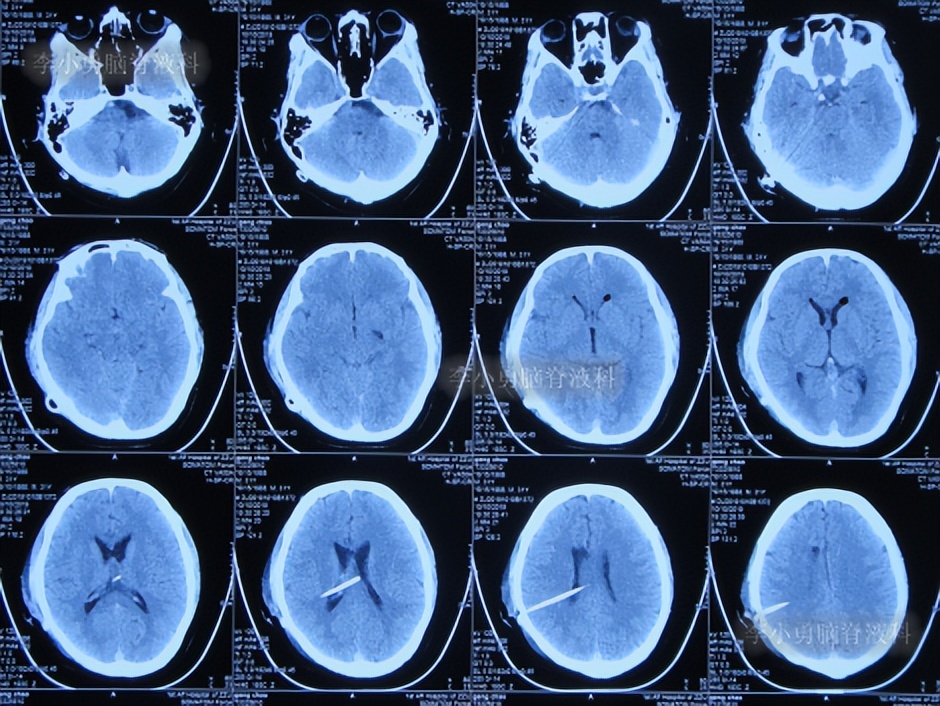 脑积水三脑室造瘘多久能恢复,脑囊虫手术后脑积水