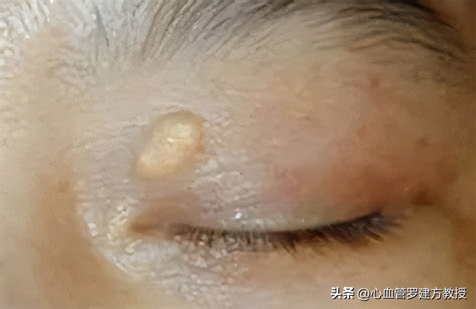 高血脂眼皮黄斑怎么办,眼皮长白色疙瘩是血脂高么