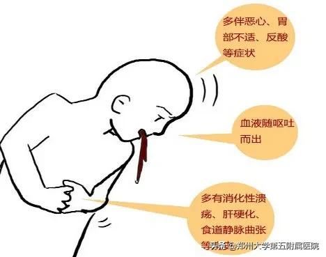 食管胃底静脉曲张破裂二次出血,胃底静脉曲张破裂出血致死