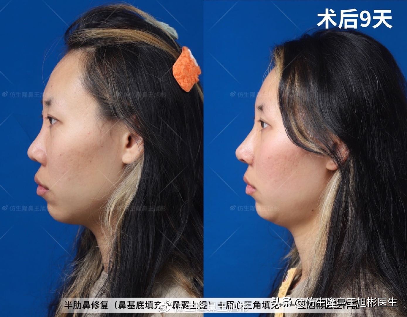 常见鼻部整形美容项目,整形鼻和自然鼻