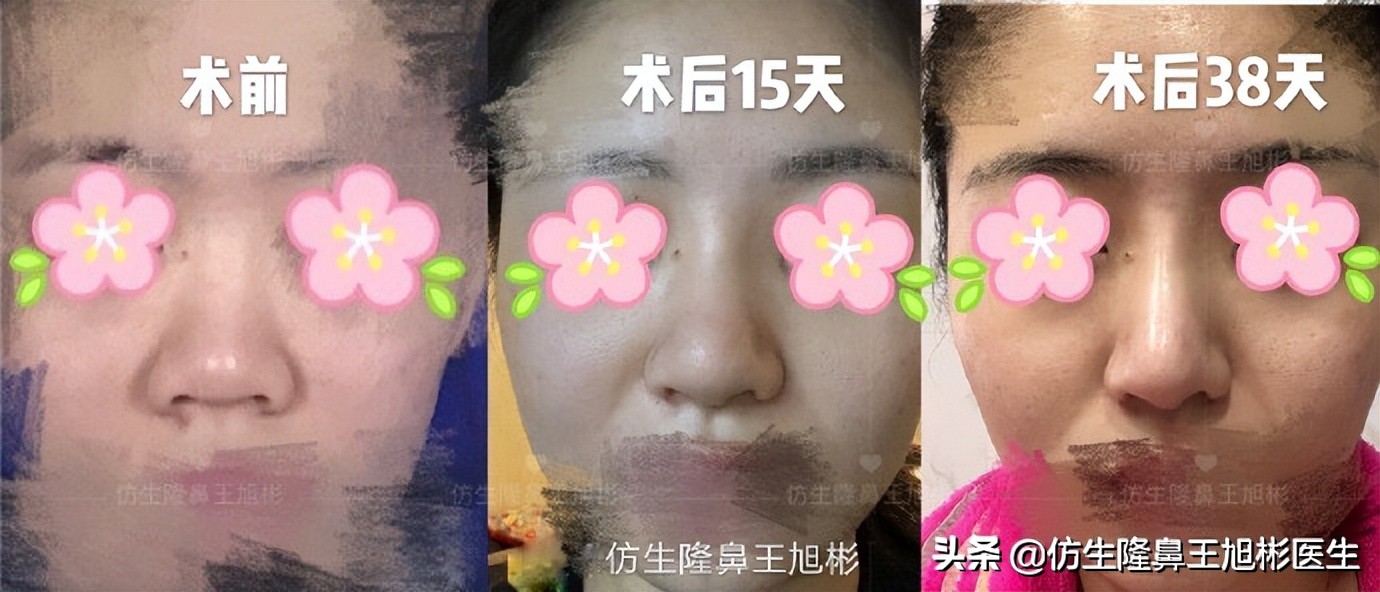 隆鼻鼻头大是失败了吗,大鼻头隆鼻手术案例
