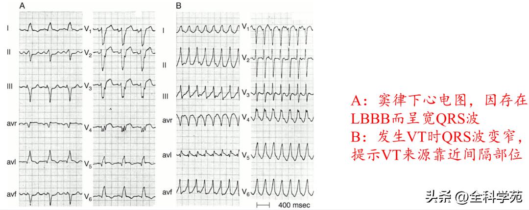 心电图上表现为宽qrs波,心电图中qrs是代表心动过速吗