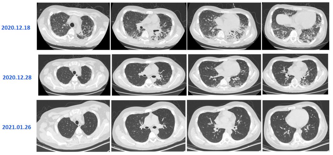 hiv感染肺孢子菌肺炎,hiv患者检查出耶氏肺孢子菌