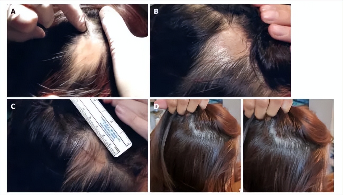 秃头康复,秃头可通过头疗生发吗