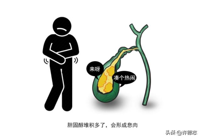 中医胆囊息肉和胆囊结石中药配方,胆囊息肉0.6可以用中药消掉吗