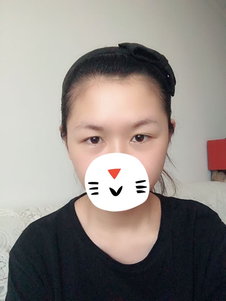 单眼皮肿眼泡消肿后能变成内双吗,单眼皮肿眼泡眼睛还能变好看吗