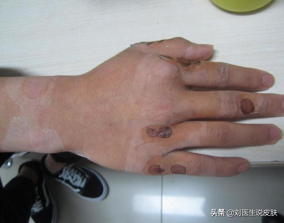 手部的白癜风怎样能治好,手部白癜风怎么治疗最好