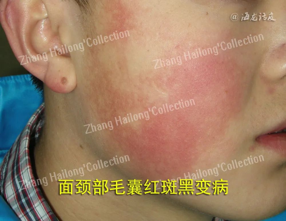 如何拯救鸡皮肤,如何拯救油腻鸡皮肤