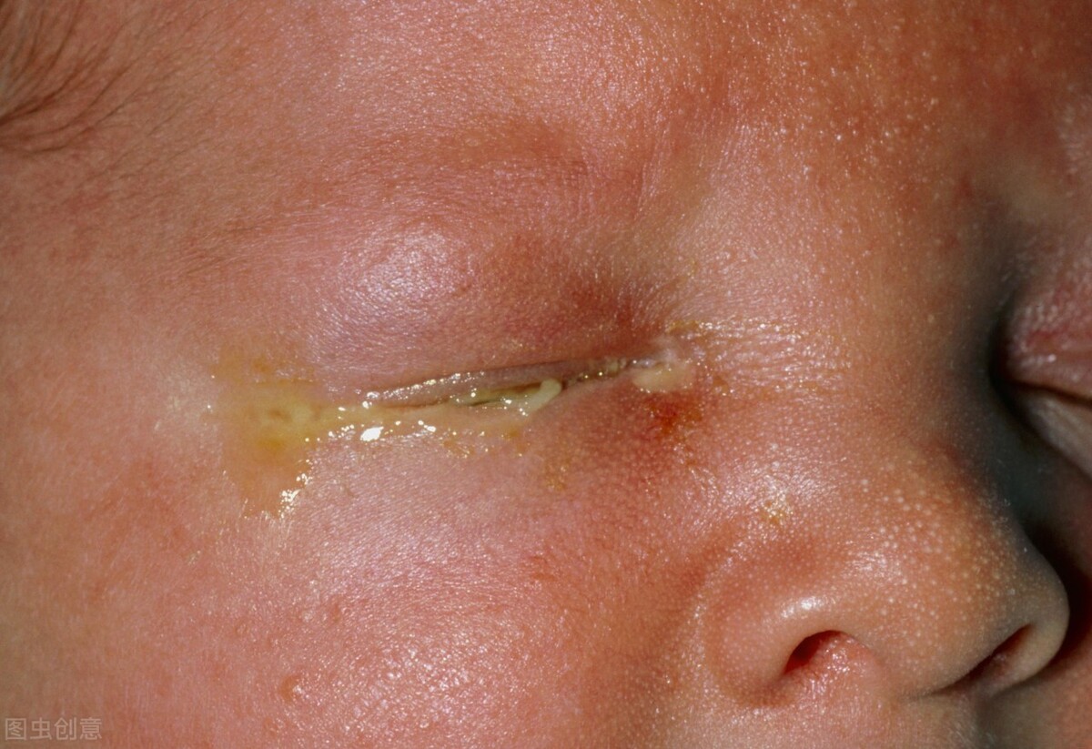 结膜炎有哪些症状,变应性结膜炎症状