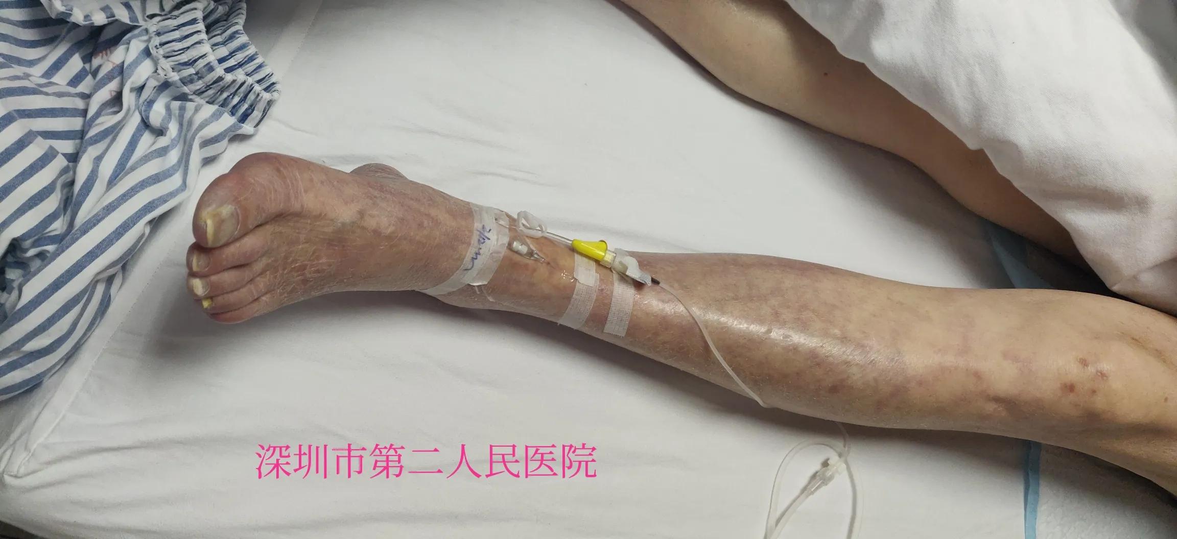 老年人小腿浮肿发紫什么原因,老人突然小腿发凉发软