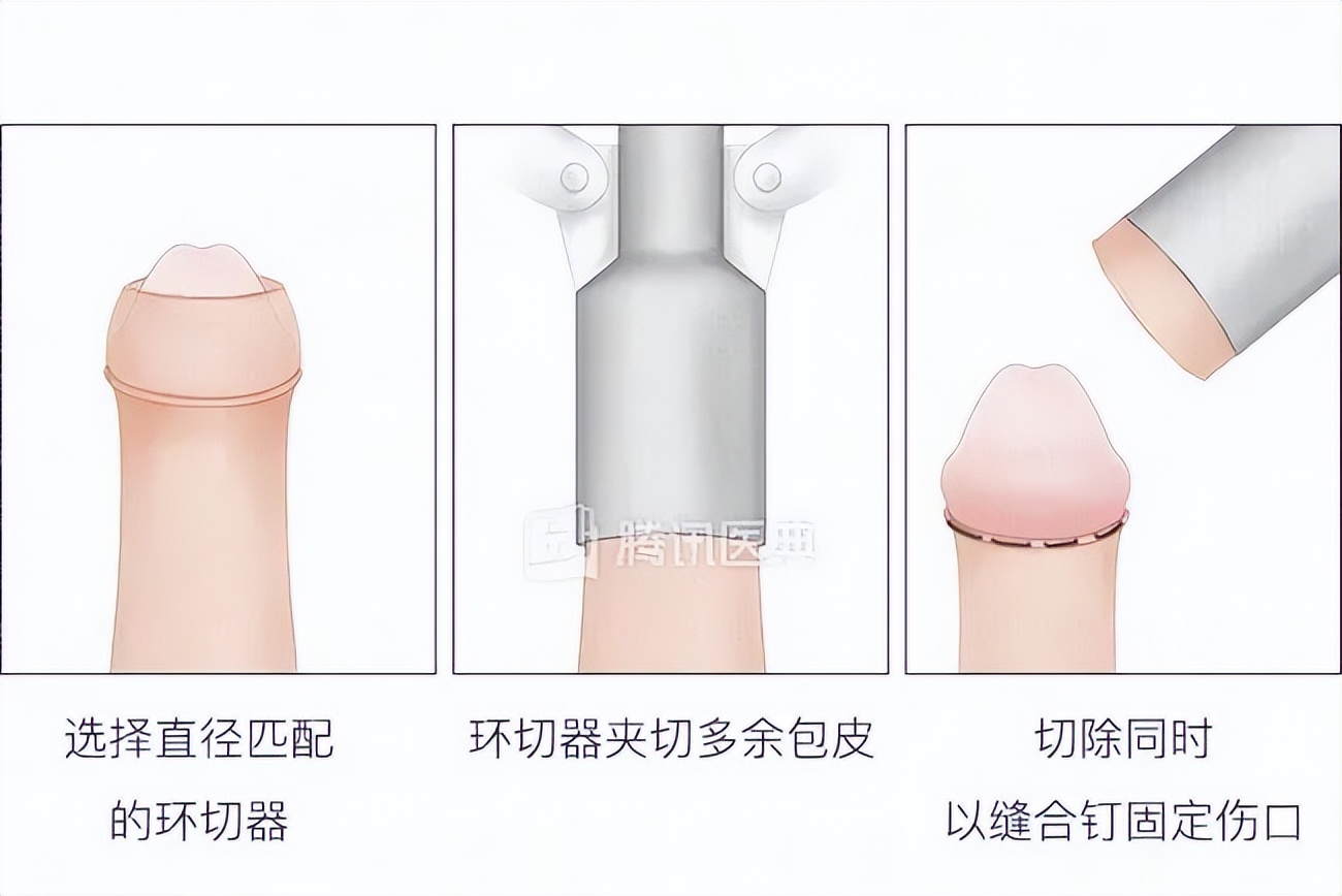 割吗?割啊!我在割包皮的医院走廊,唱完整首孤勇者